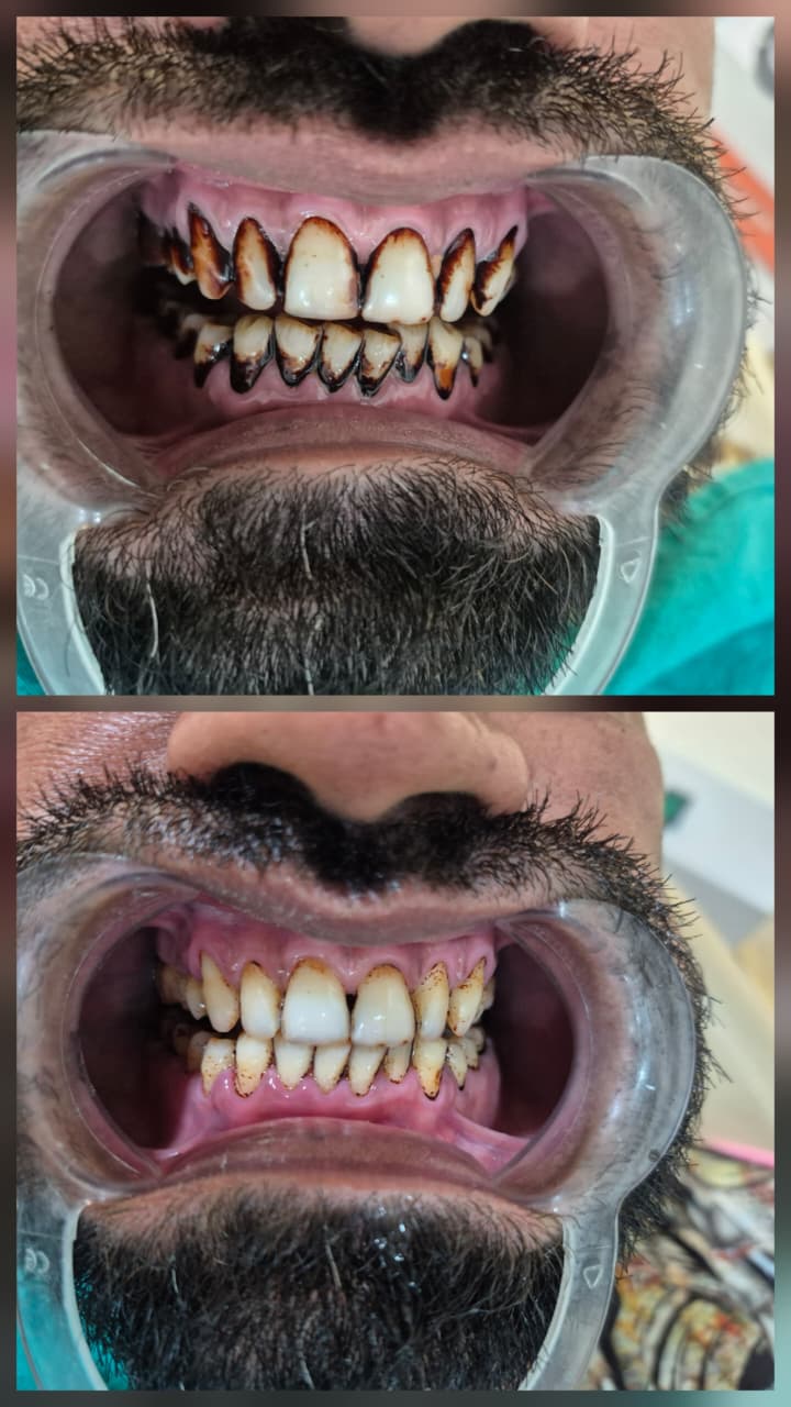 Before and after smile transformation 1